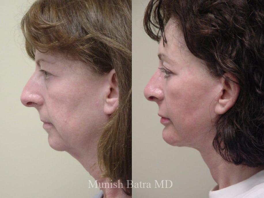 Before and After Image