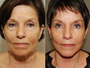 Before and After Image