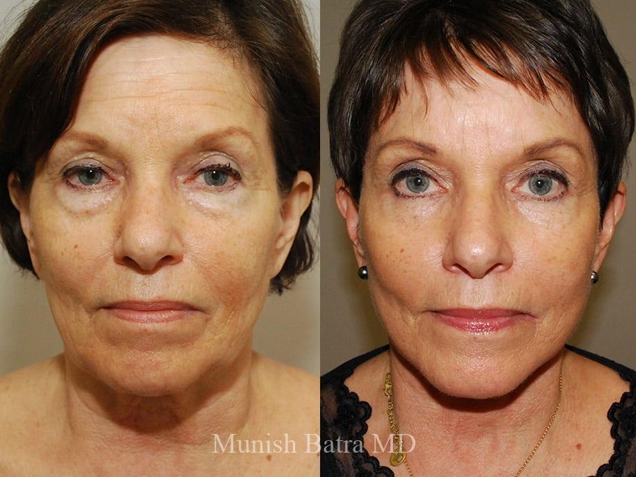 Before and After Image