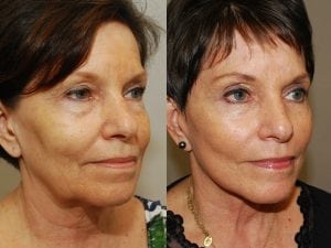 Before and After Image