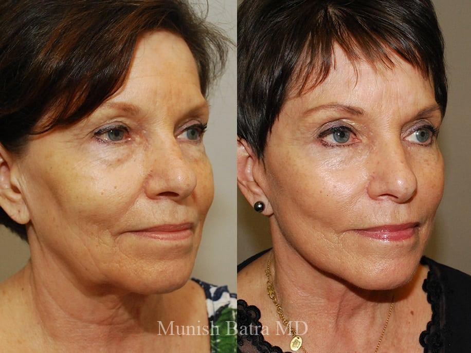 Before and After Image