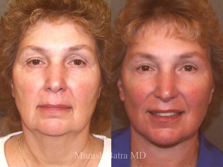 Before and After Image
