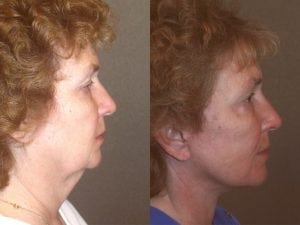 Before and After Image