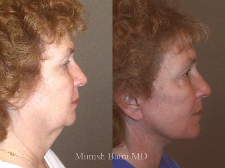 Before and After Image