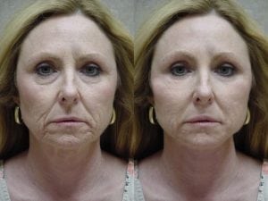 Before and After Image