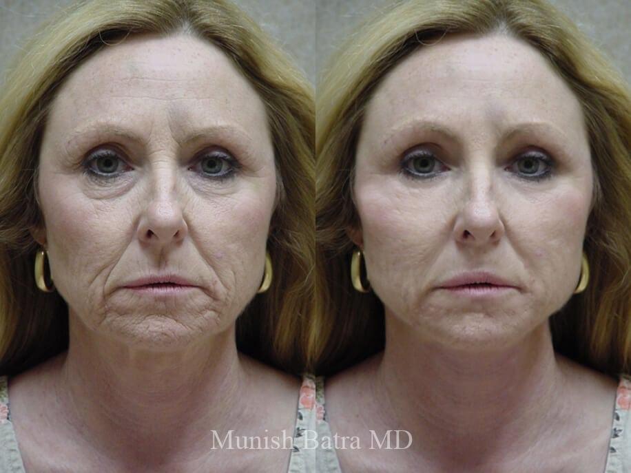 Before and After Image