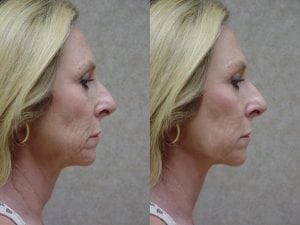 Before and After Image