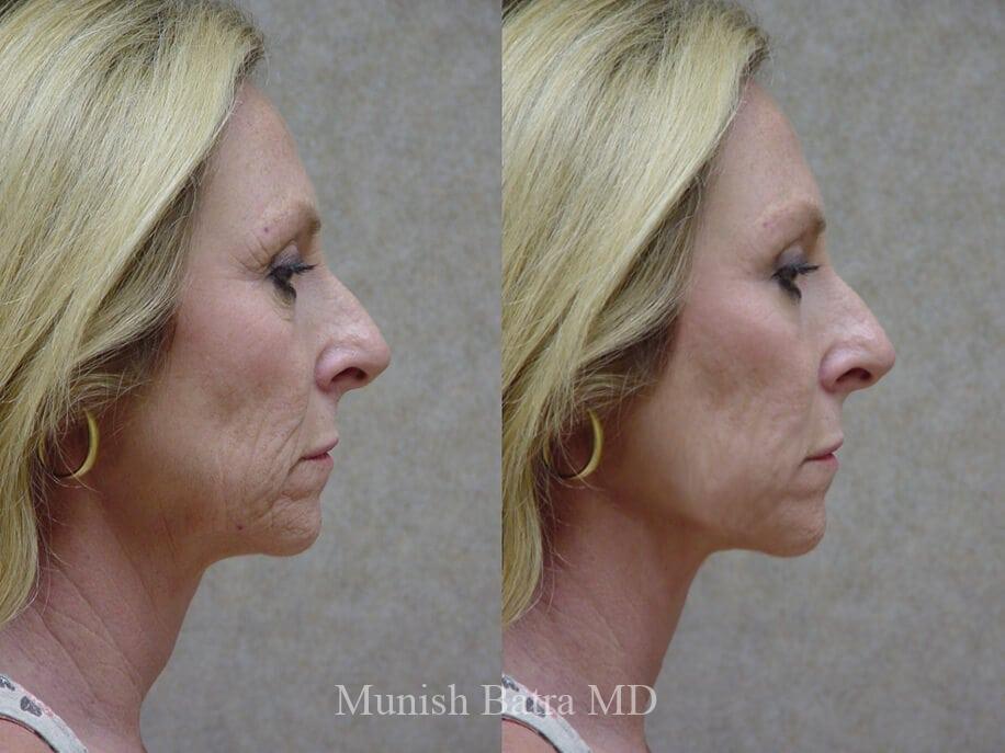 Before and After Image