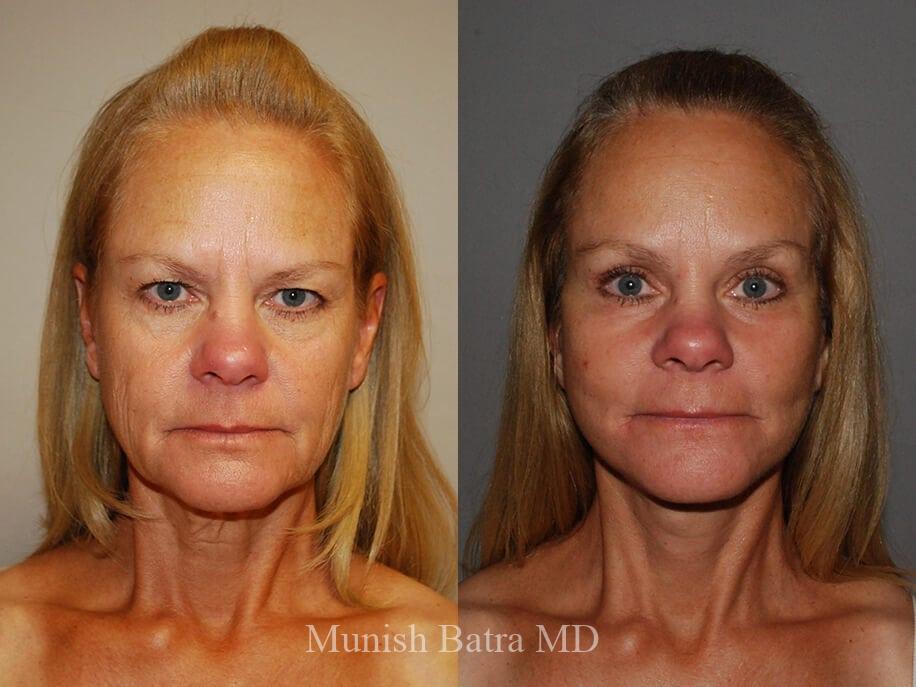 Before and After Image