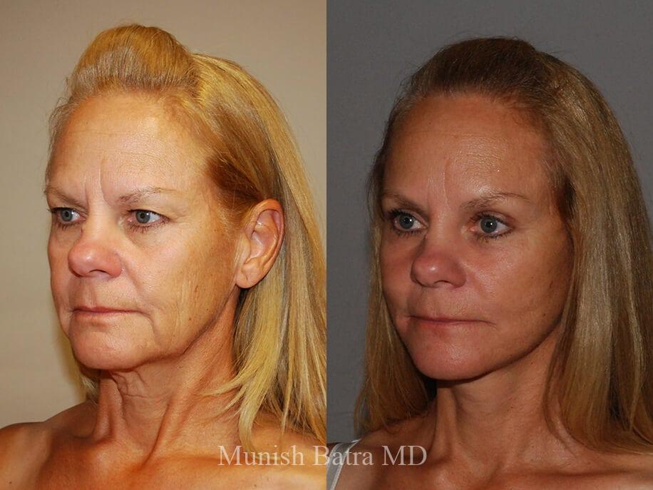 Before and After Image