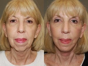 Before and After Image