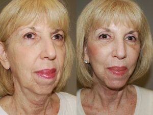 Before and After Image