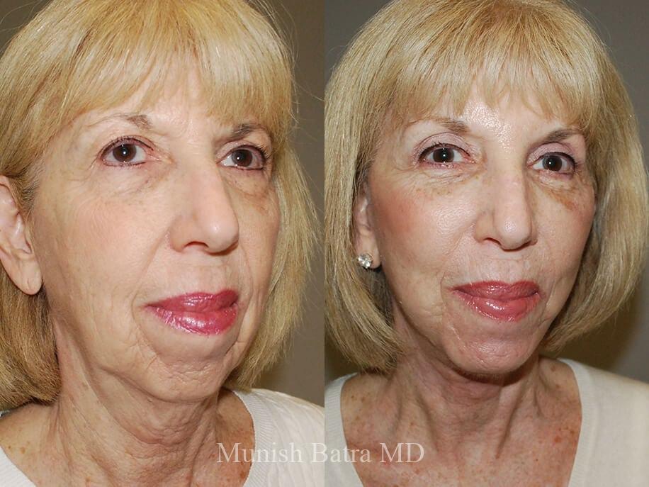 Before and After Image