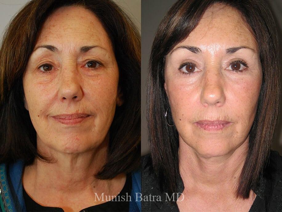 Before and After Image