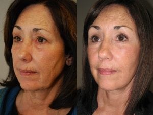 Before and After Image