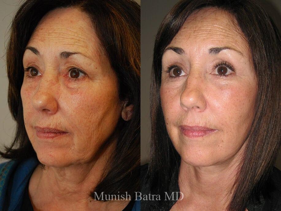 Before and After Image