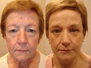 Before and After Image