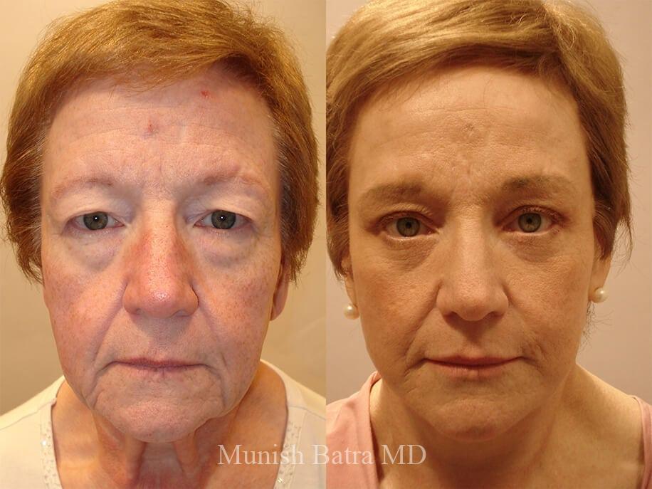 Before and After Image