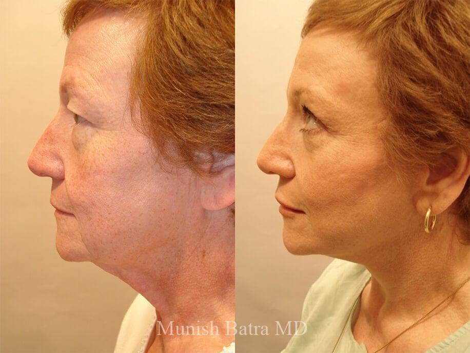 Before and After Image