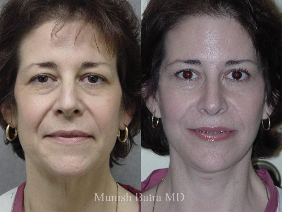 Before and After Image