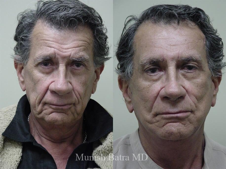 Before and After Image