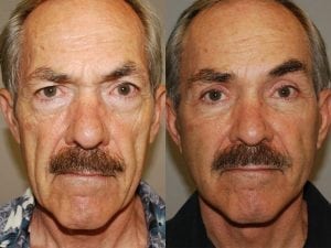 Before and After Image