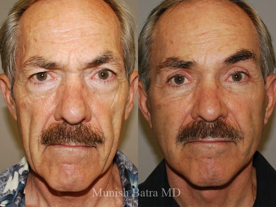 Before and After Image