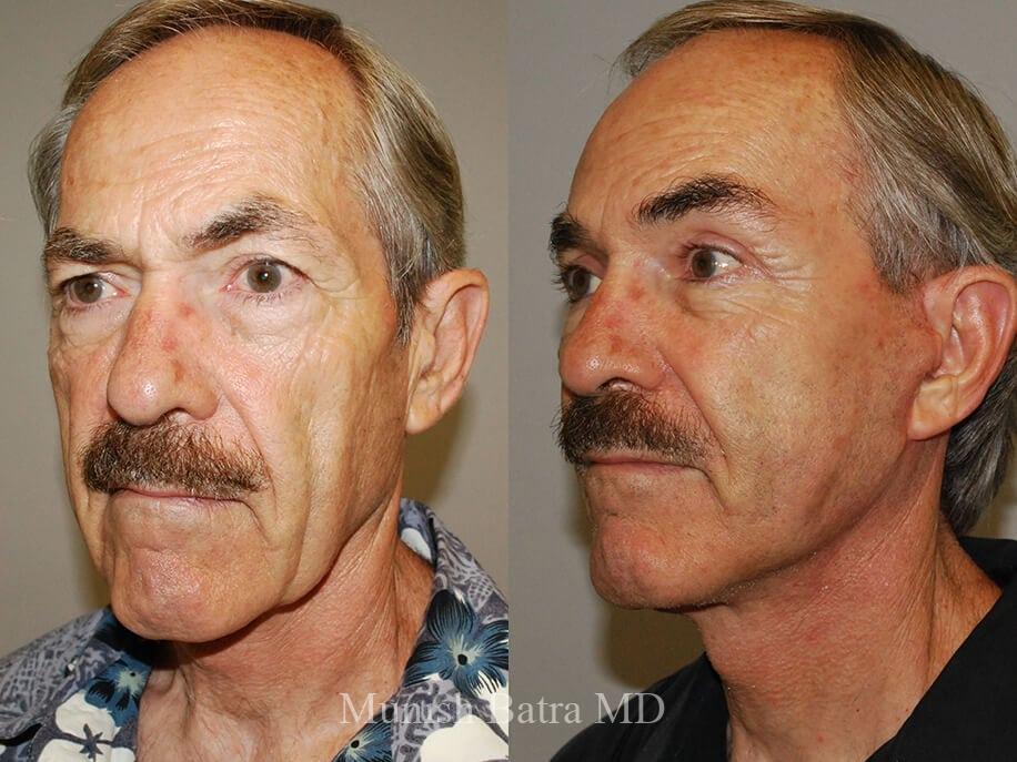 Before and After Image