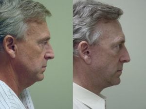 Before and After Image