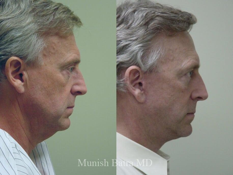 Before and After Image