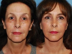 Before and After Image