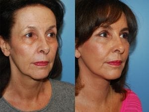 Before and After Image