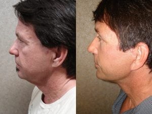 Before and After Image