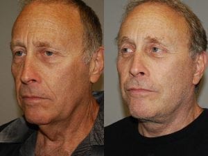 Before and After Image