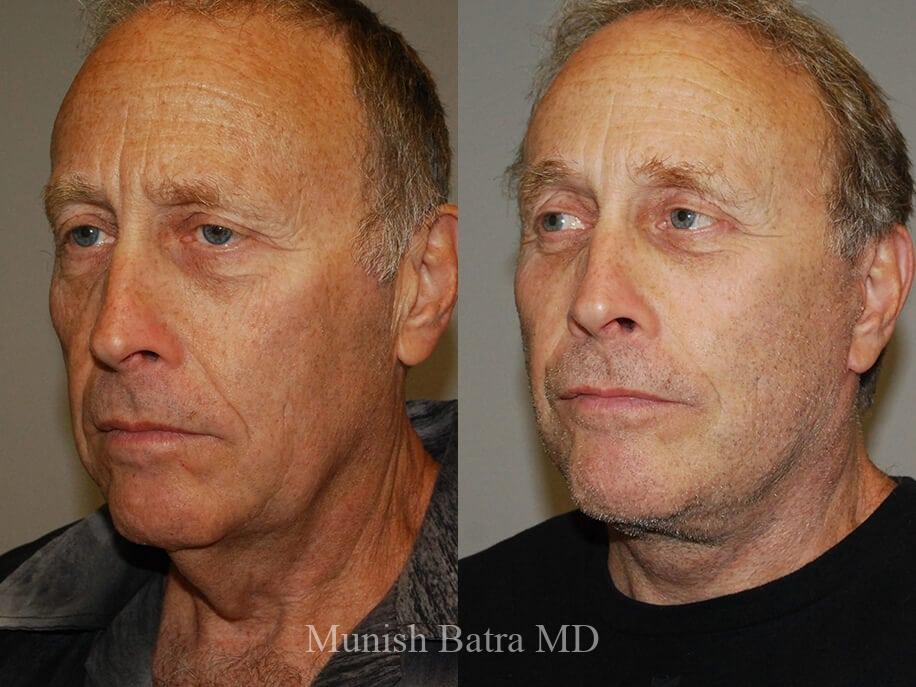 Before and After Image