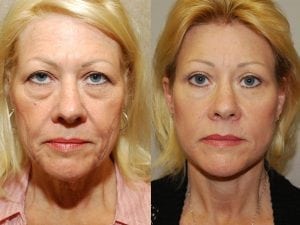 Before and After Image