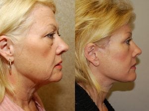 Before and After Image