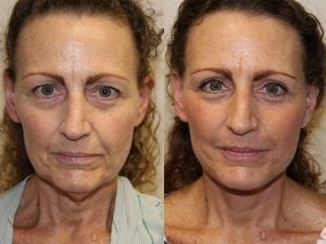 Before and After Image