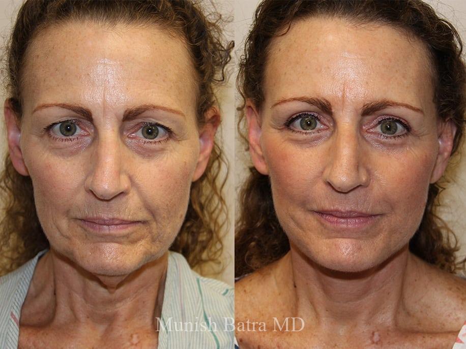 Before and After Image