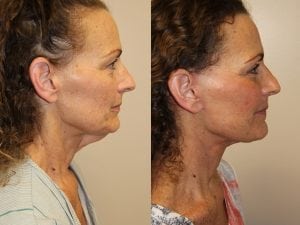 Before and After Image
