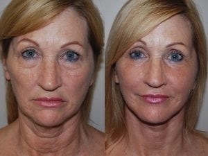 Before and After Image