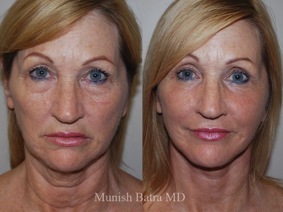Before and After Image
