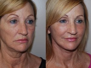Before and After Image