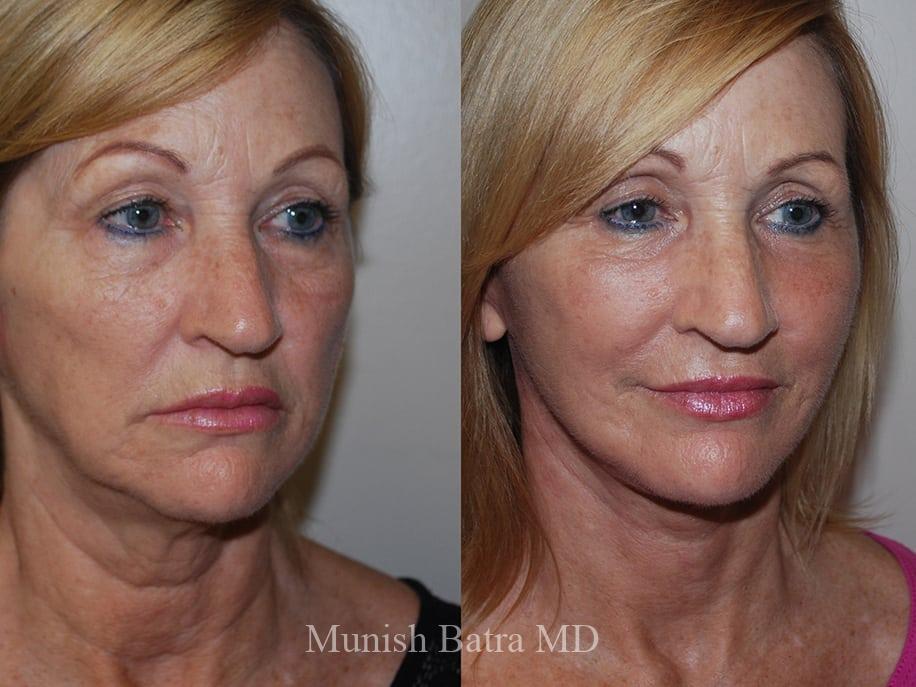 Before and After Image