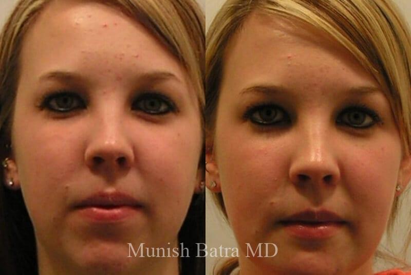 Before and After Image