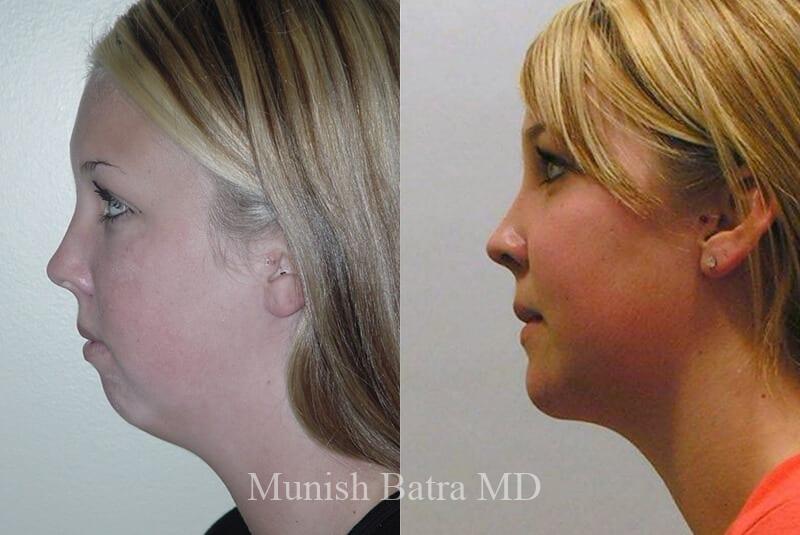 Before and After Image