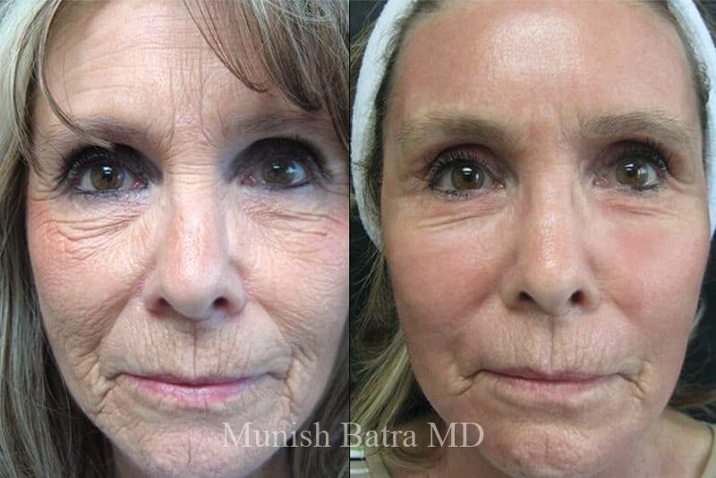 Before and After Image