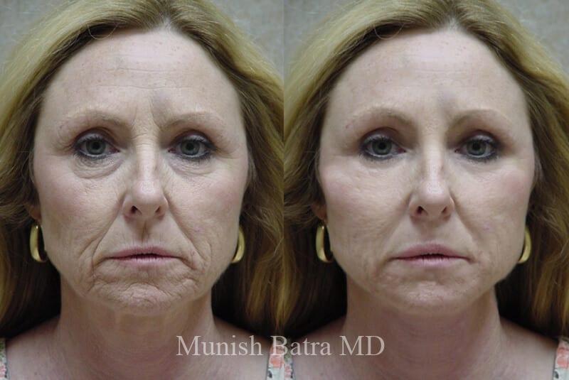 Before and After Image