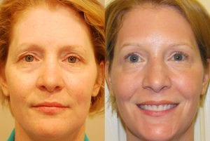 Before and After Image