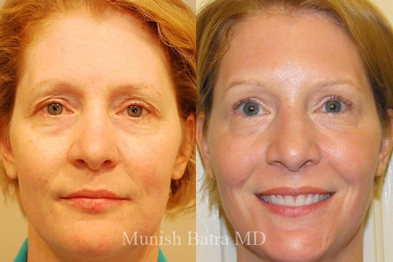 Before and After Image